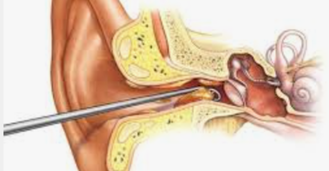 Professional Ear Cleaning & Ear Wax Removal in Humble and Kingwood, TX image