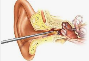 Ear Cleaning in Humble 